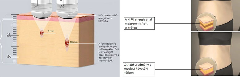 HIFU kezelés Miksolcon a Kék Sziget Szépségszalonban