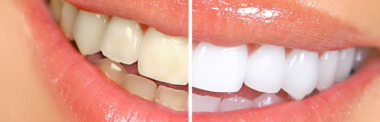 Legyen csodaszép mosolyod fogszabályzás közben is, kedvezményes DD kuponunkkal, a Mosolygyár Fogászatban!