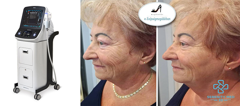 Senerity MED 3D HIFU arcra