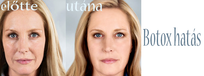 Botox hatás