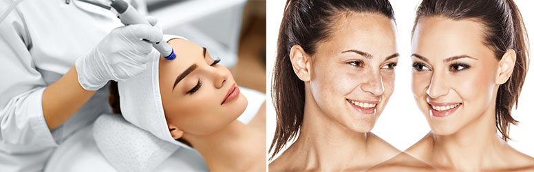 10 alkalmas DiamondDeal kedvezményes kezelésed során a pigmentfoltok, hegek, pattanások, aknék eltűnnek arcodról, a XI. kerületi Holisztikus Kozmetikában!