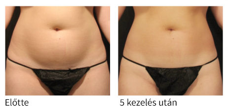 Velashape kezelés eredményei a has területén