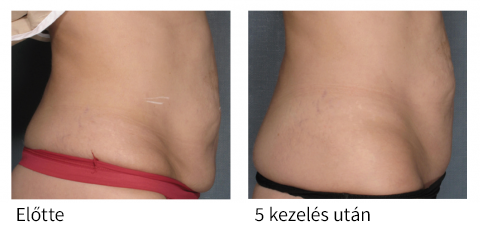 Velashape kezelés eredményei a has területén