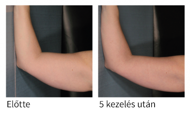 Velashape kezelés eredményei a karon