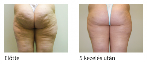 Velashape kezelés eredményei a fenék területén