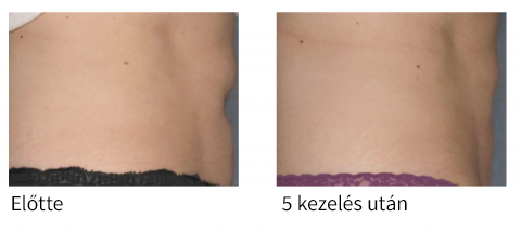 Velashape kezelés eredményei