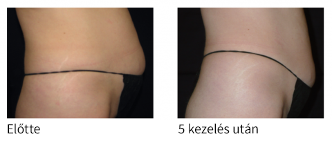 Velashape kezelés eredményei