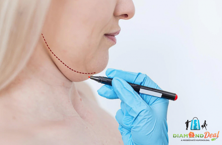 2 alkalmas toka eltüntetés ajándék felkar feszítéssel a XIV. kerületben!