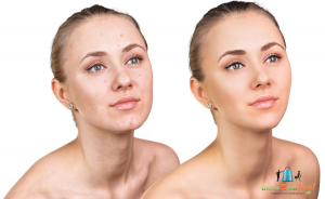 5 alkalmas bőrszépítő kezelés lézeres toll segítségével. Stop a pattanásoknak!