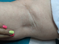 Teljes intim és hónalj szőrtelenítés cukor gyantával + Teljes láb és kar gyantázás