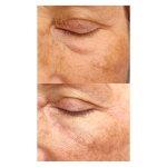 Nanosoft tűs eljárással történő ránctalanító, arcfiatalító kezelés 1 ml vagy 2 ml hatóanyaggal