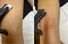 Mondj búcsút a seprűvénáknak! - RBS-C rosacea, hajszálér tűzfolt lézeres kezelés tenyérnyi területen