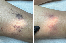 Mondj búcsút a seprűvénáknak! - RBS-C rosacea, hajszálér tűzfolt lézeres kezelés tenyérnyi területen