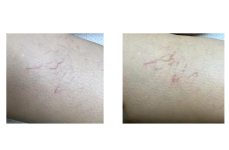 Mondj búcsút a seprűvénáknak! - RBS-C rosacea, hajszálér tűzfolt lézeres kezelés tenyérnyi területen
