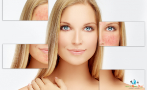 Rosacea kezelés nagyteljesítményű, fizikoterápiás lézerrel, speciális géllel a XI. kerületben
