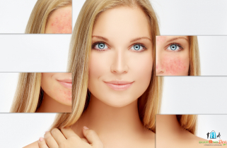 Rosacea kezelés nagyteljesítményű, fizikoterápiás lézerrel, speciális géllel a XI. kerületben