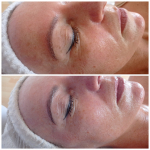 Tű nélküli ránctalanítás - Rádiófrekvenciás arcfiatalítás botox hatású szérummal