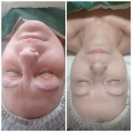 Tű nélküli ránctalanítás - Rádiófrekvenciás arcfiatalítás botox hatású szérummal