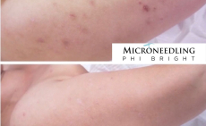 Hatékony orvoslás a bőrproblémák ellen: Phibright kezelés rollerrel, vagy stamppel