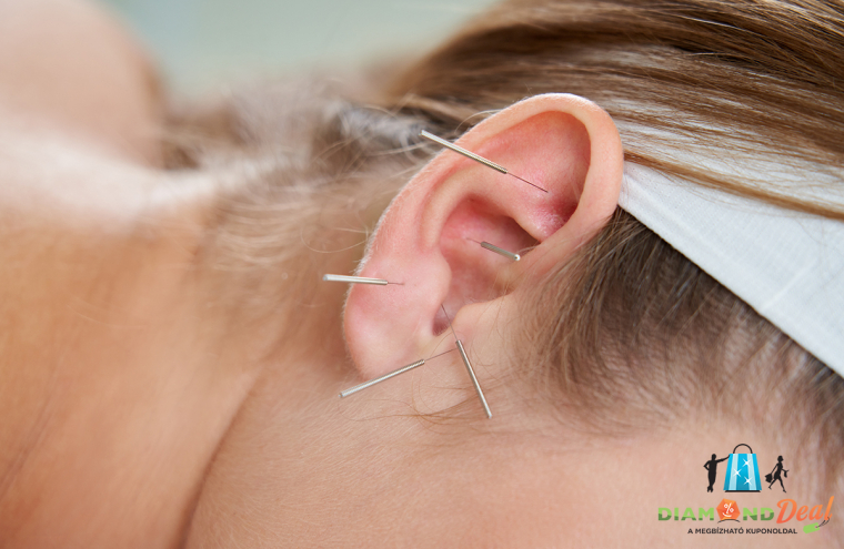 Tarts karban tested és javítsd általános jólléted! -  60 perces fülakupunktúrás kezelés