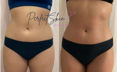 Hatásos narancsbőr kezelés: Vákuumos Rádiófrekvencia + választható Vákuum Roller/Bioáramos kezelés