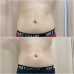 Hatásos narancsbőr kezelés: Vákuumos Rádiófrekvencia + választható Vákuum Roller/Bioáramos kezelés