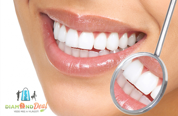 Gondolj fogaid esztétikus megjelenésére! -  LED lámpás peroxidmentes fogfehérítés a XIII.kerületben