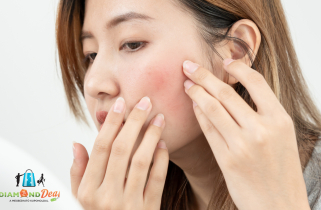 Gyors segítség rosacea ellen – most kedvezményes lézeres kezeléssel, XI. kerületben