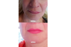 Tű nélküli száj- és ráncfeltöltés hyaluron pennel a XX. kerületben