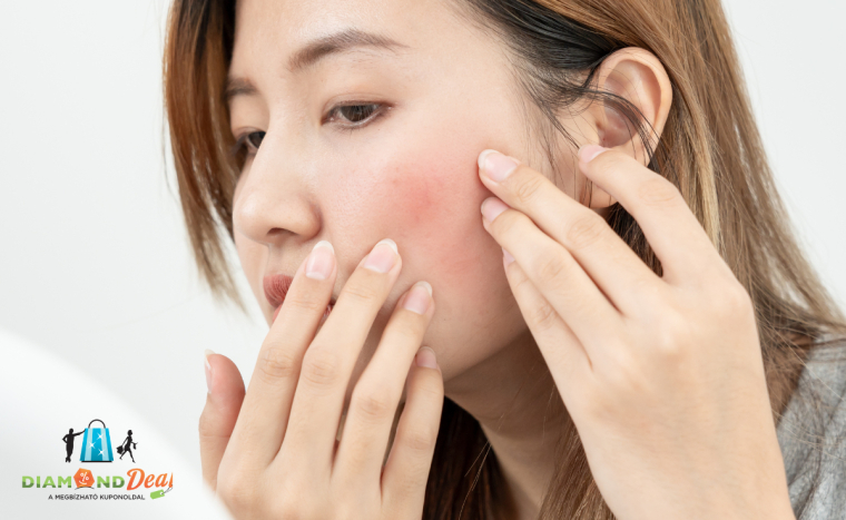 Gyors segítség rosacea ellen – most kedvezményes lézeres kezeléssel, XI. kerületben