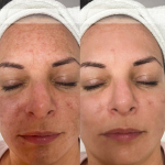 Szabadulj meg a bőrhibáktól 2x2 cm-es választható területen az ND YAG Pico lézerrel, XIII. kerület