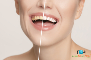 Ultrahangos fogkőeltávolítás fehérítő hatású polírozássa+GC Tooth mousse kezelèsse, XIII.kerületben