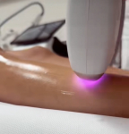 Tartós szőrtelenítés hónalj vagy bikini vonal területre: SHR vagy Dióda lézerrel, a XIII. kerületben