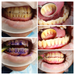 Fogkő, lepedék, ínygyulladás ellen – fájdalommentes EMS biofilm terápia a Hollán Dentálnál