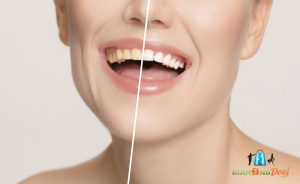 Ultrahangos fogkőeltávolítás fehérítő hatású polírozássa+GC Tooth mousse kezelèsse, XIII.kerületben