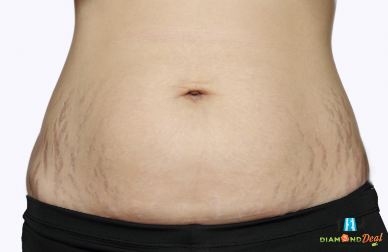 Striák és hegek kezelése gyémántfejes mikrodermabrázióval, akár 4 tenyérnyi választható területen!