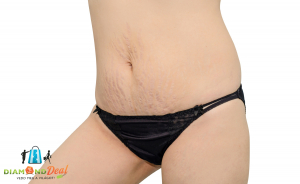 Striák, terhességi csíkok, hegek eltávolítása mikrodermabrázióval választható területen a Blahánál