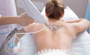 3 alkalmas lézeres tetoválás eltávolítás akár sminktetoválásra is