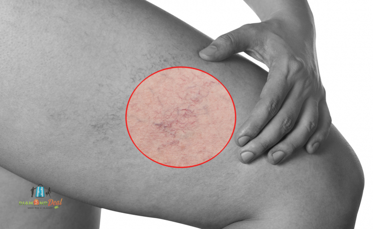 Seprűvéna kezelés professzionális E-light technológiával, hogy visszakapd vonzó lábaid!