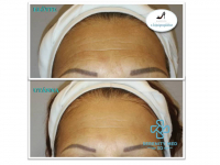 Műtét nélküli Serenity MED 3D HIFU arcfiatalító kezelések kis területekre, a Móricz Zs. körtérnél