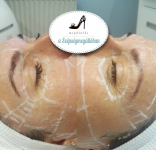 Műtét nélküli Serenity MED 3D HIFU arcfiatalító kezelések kis területekre, a Móricz Zs. körtérnél