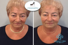 Műtét nélküli Serenity MED 3D HIFU arcfiatalító kezelések kis területekre, a Móricz Zs. körtérnél