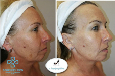 Műtét nélküli Serenity MED 3D HIFU arcfiatalító kezelések kis területekre, a Móricz Zs. körtérnél