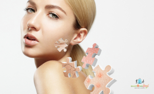 Ints búcsút a kellemetlen bőrtüneteknek! Rosacea kezelés fizikoterápiás lágy lézerrel