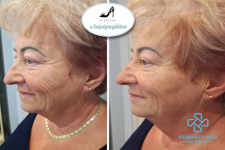 Műtét nélküli Serenity MED 3D 11 soros HIFU arcfiatalító és bőrfeszesítő kezelések nagy területekre