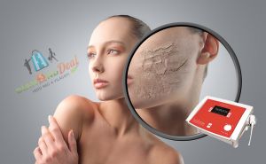 Csúcskategóriás hialurox softlézeres arcfeltöltés 1 vagy 3 alkalomra a Beauty Zoneban!
