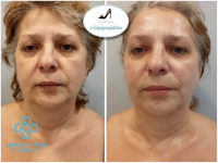 Heg nélküli Serenity MED 3D HIFU bőrfeszesítő kezelés -teljes arc, nyak, toka, dekoltázs területre!