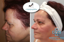 Heg nélküli Serenity MED 3D HIFU bőrfeszesítő kezelés -teljes arc, nyak, toka, dekoltázs területre!