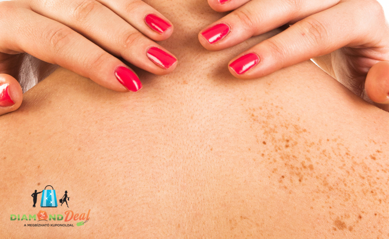 Kezeld egyszerűen a pigmentfoltokat vagy a hegeket a thermikus ionizációval