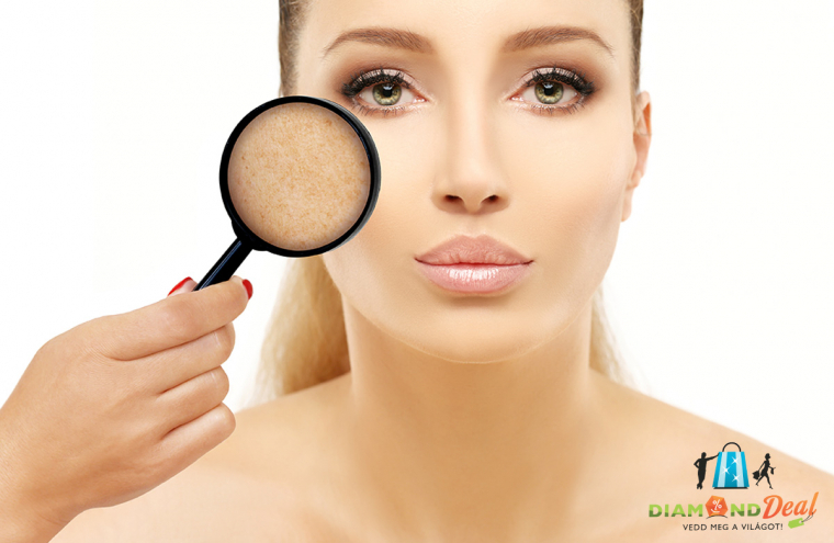 Hegek, striák, vitiligók, szem alatti karikák eltüntetése, halványítása bármely területen